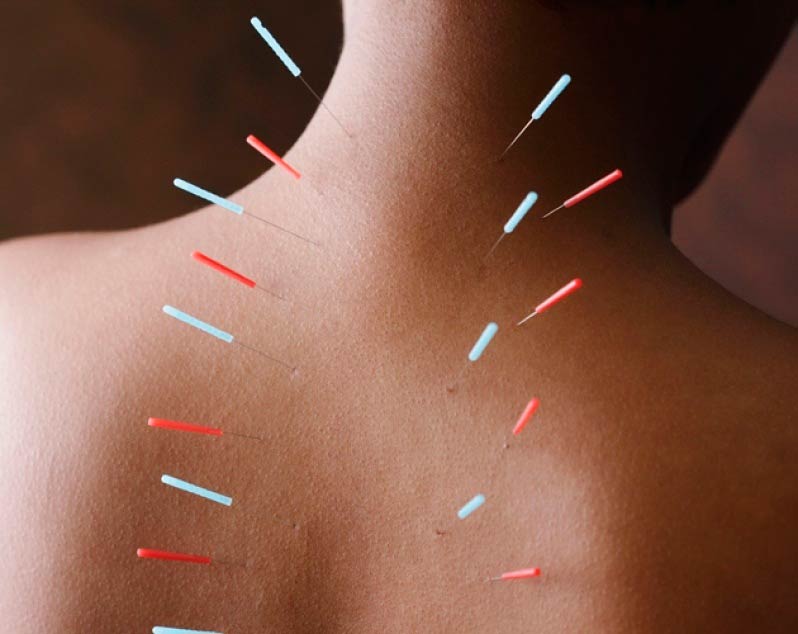 Acupuntura no tratamento das dores nas costas