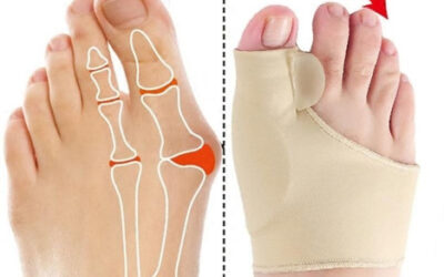 Dedos sobrepostos – deformidade dos dedos do pé