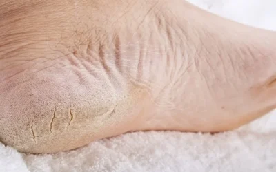 Problemas de pele nos pés