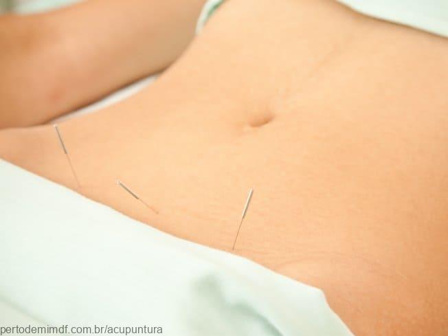 Alívio da cólica menstrual com acupuntura