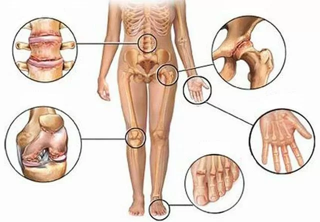 Dores Articulacoes
