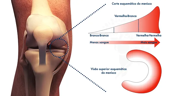 Lesões de meniscos