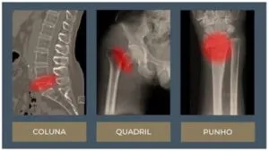 Fratura Osteoporose