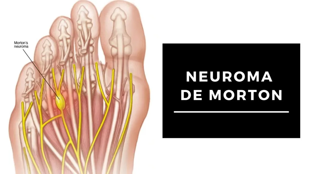 Neuroma De Morton