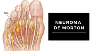 Neuroma De Morton