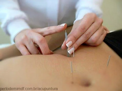 Acupuntura No Emagrecimento Conaacup